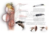 Аппарат высокоинтенсивной лазерной терапии HILTerapia ASAlaser в исполнении HIRO 3.0