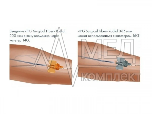 Волоконный радиальный инструмент для ЭВЛК IPG Surgical Fiber Single-Use Radial